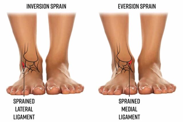 Medial and Lateral Ankle Sprain Dr Dinesh