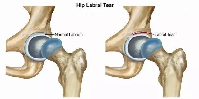 Hip Labrum Tears Anatomy