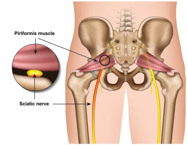 Piriforimis Syndrome Diagram