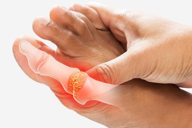Foot Gout Treatment