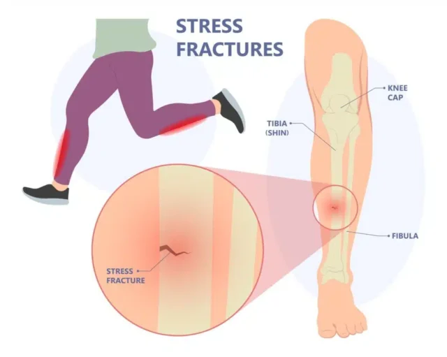 Tibial Stress Fracture