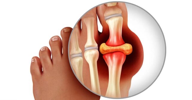Gout big toe